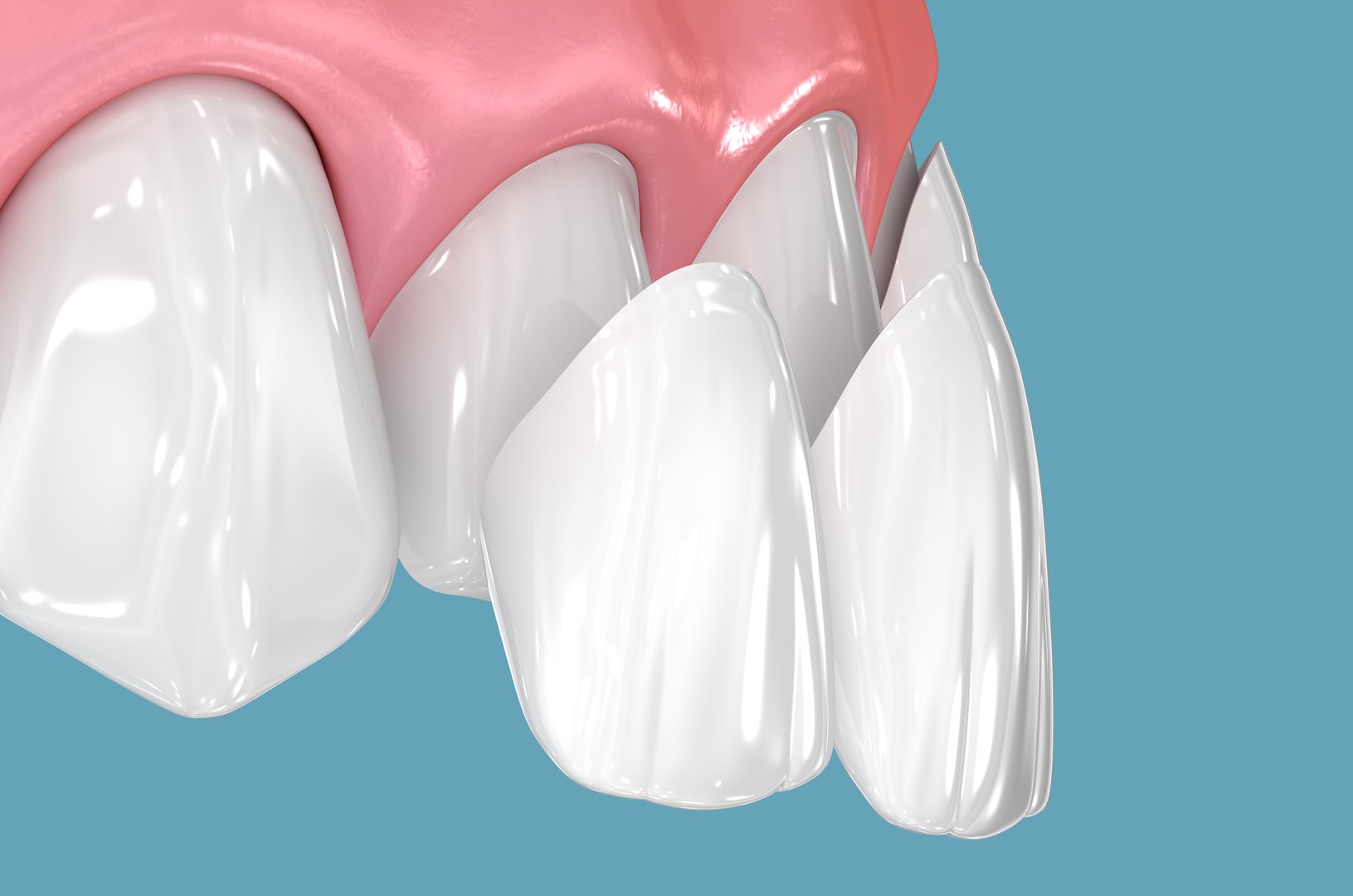 Dental veneers on blue background