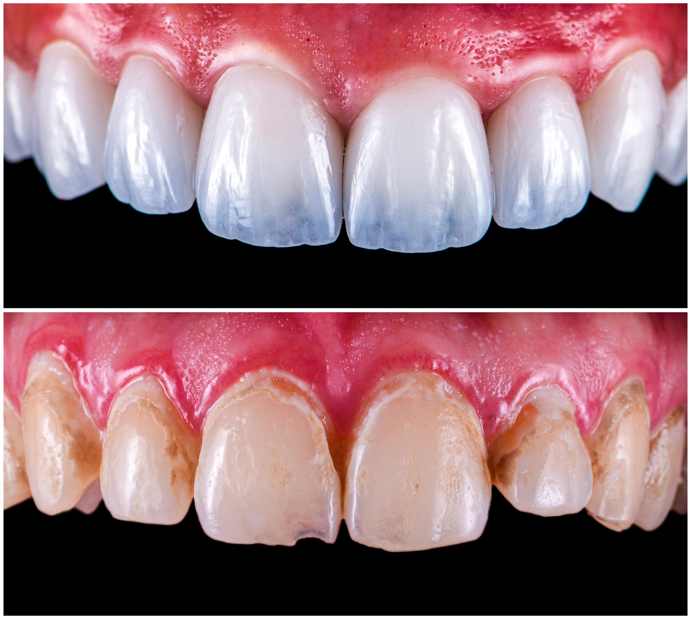 Teeth restoration with ceramic veneers