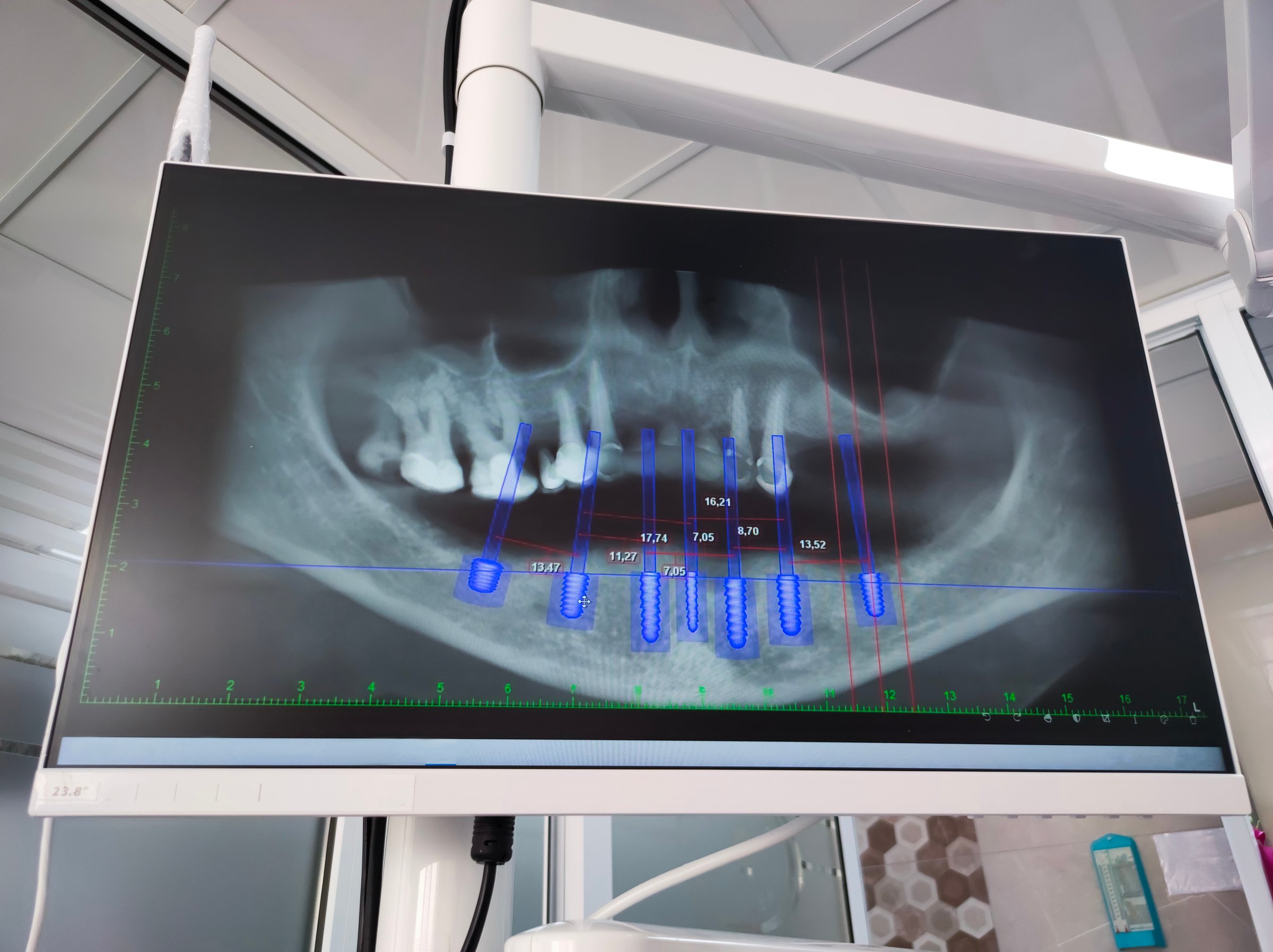 Detailed dental CT scan showing axial, coronal, sagittal, and 3D views of jaw and teeth for diagnostic and treatment planning.
