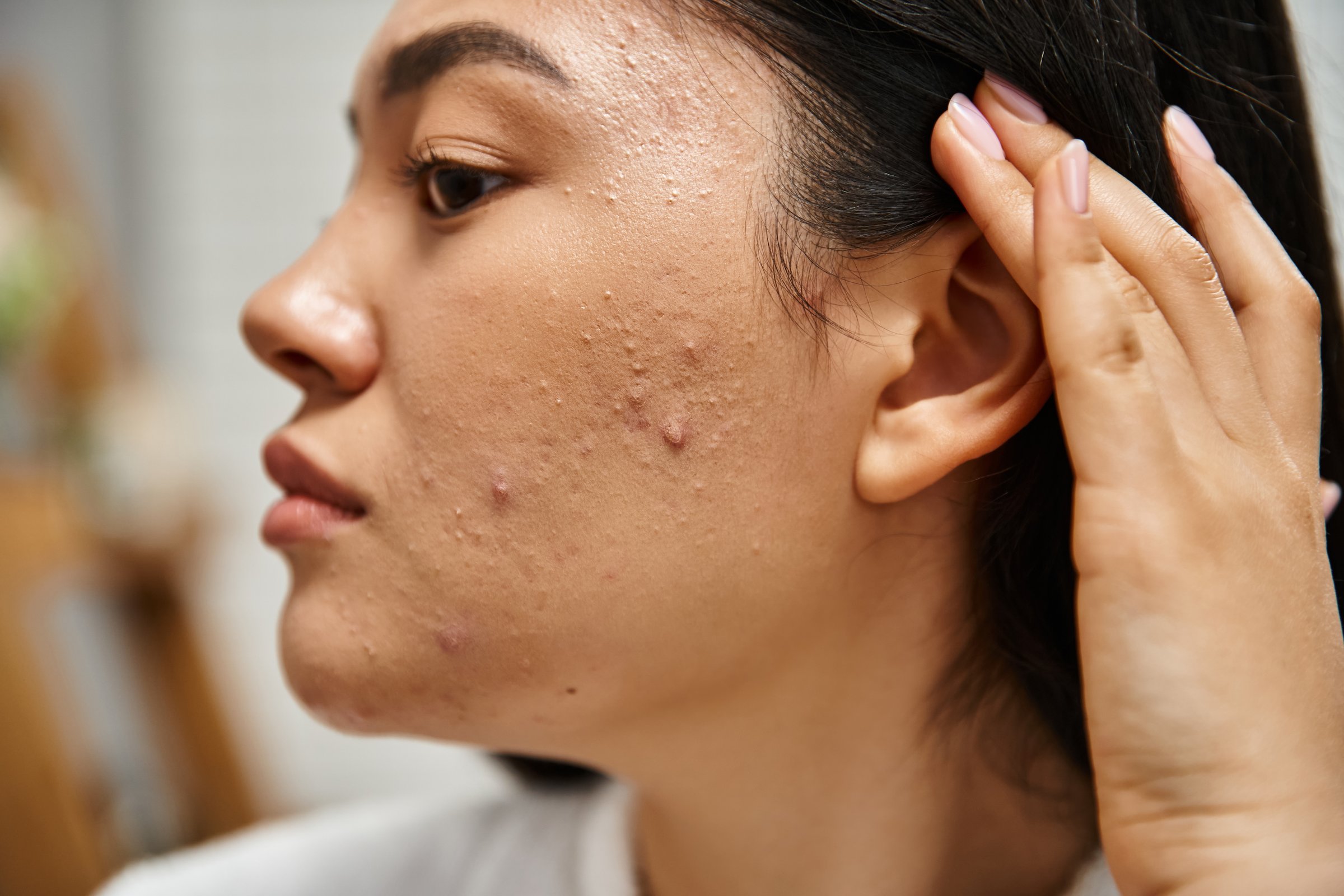 A young woman applies her skin care product, caring for her complexion and skin health.