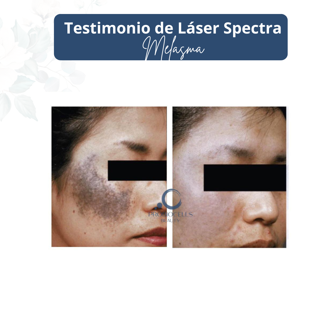 Testimonio de medicina estética - Resultado de tratamiento especializado