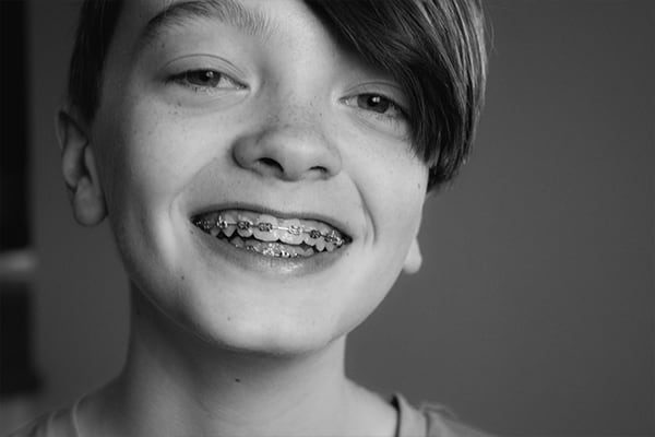 Woman with braces on her teeth is smiling. Metal bracket system on the teeth of a young woman. Shallow depth of field