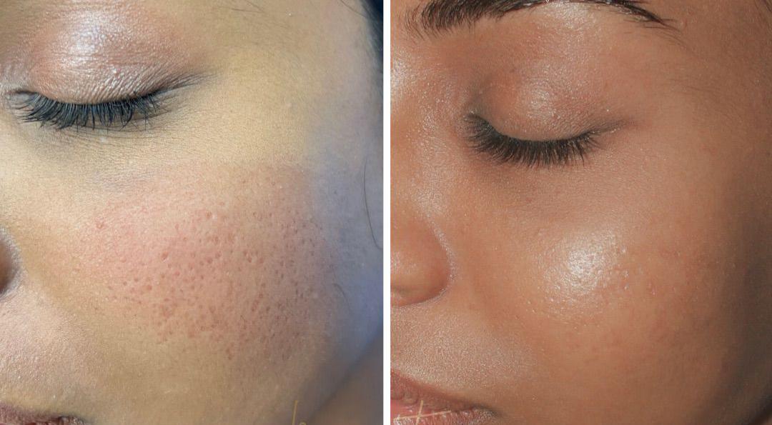 Acne scar before and after treatment