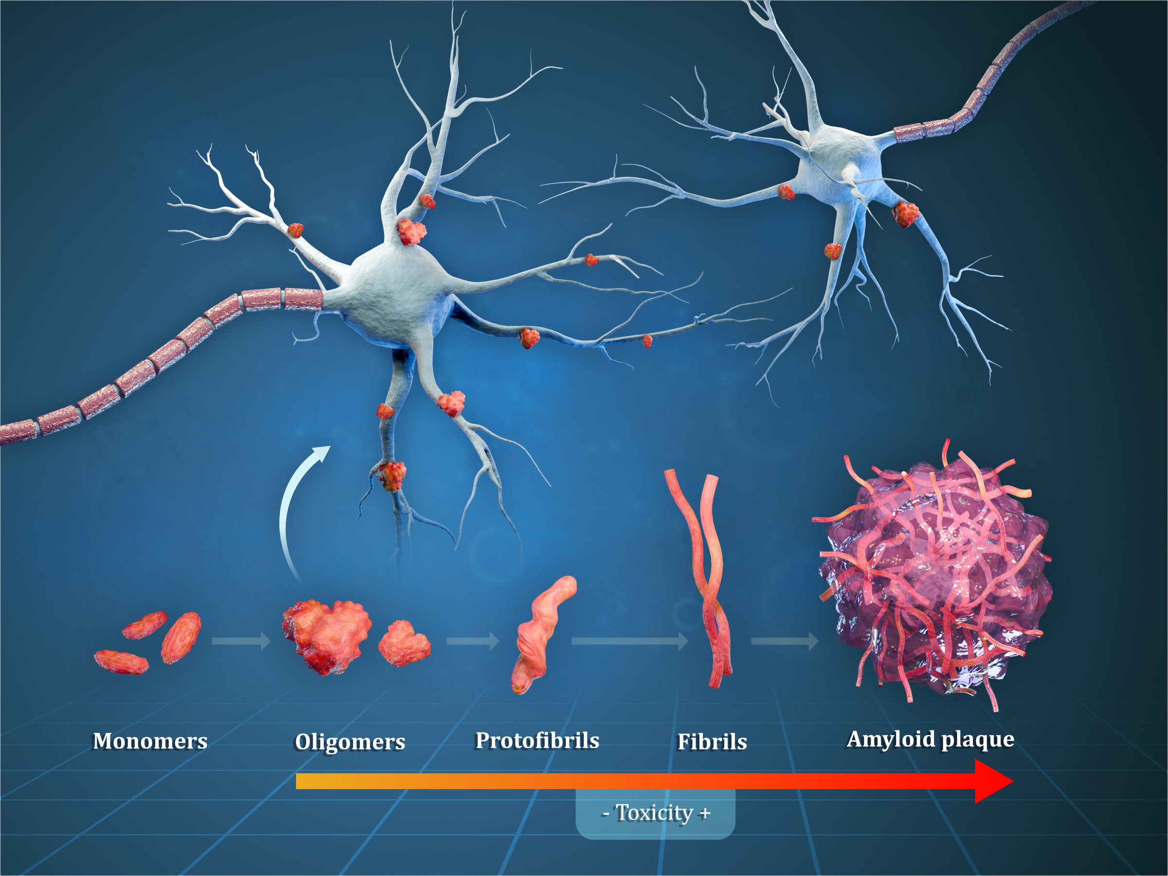 Diagram showing different steps leading to the formation of amyloid plaques in Alzheimer disease. Digital illustration, 3D render.