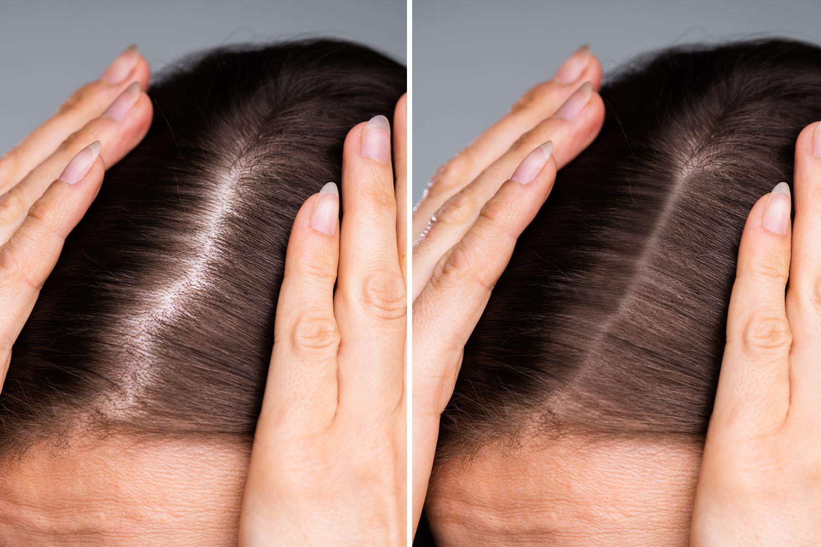 Woman Before And After Hair Loss Treatment