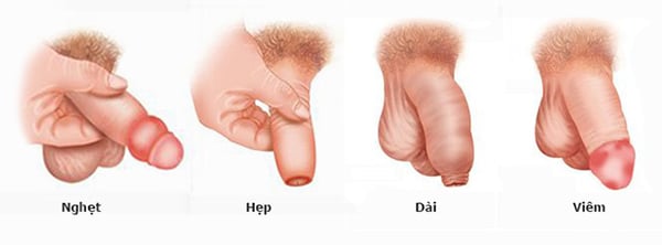 Hiểu lầm về bao quy đầu