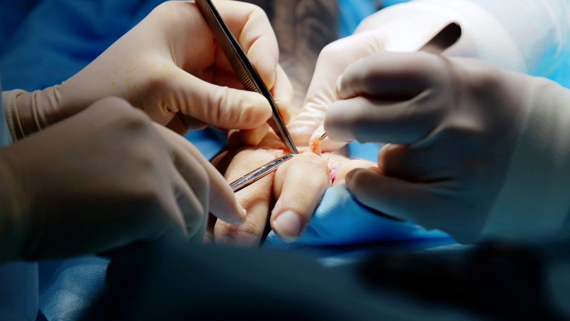 Surgeons carefully operating on a patient's hand in a sterile environment, using specialized tools and techniques