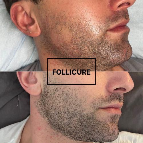 Follicure scalp treatment before and after