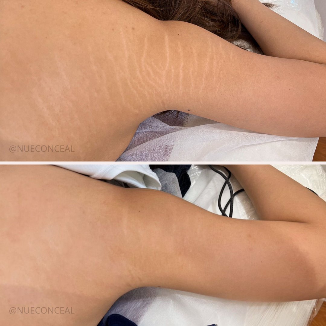 Stretch marks before and after treatment