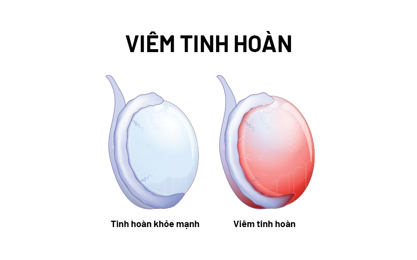 Hình ảnh minh họa viêm tinh hoàn