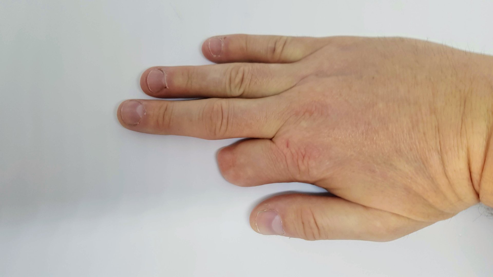 Adult white Caucasian male with a partially amputated left hand index finger.