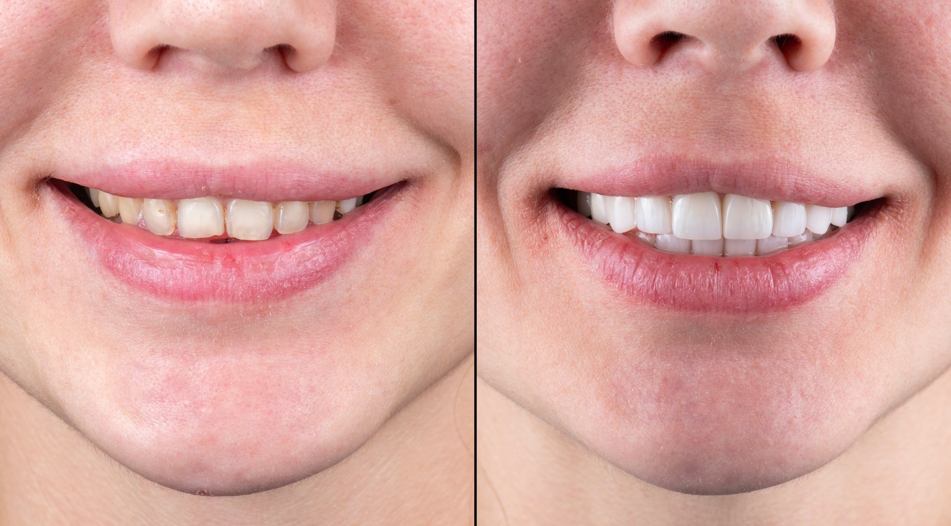 ceramic crowns and veneers before and after picture