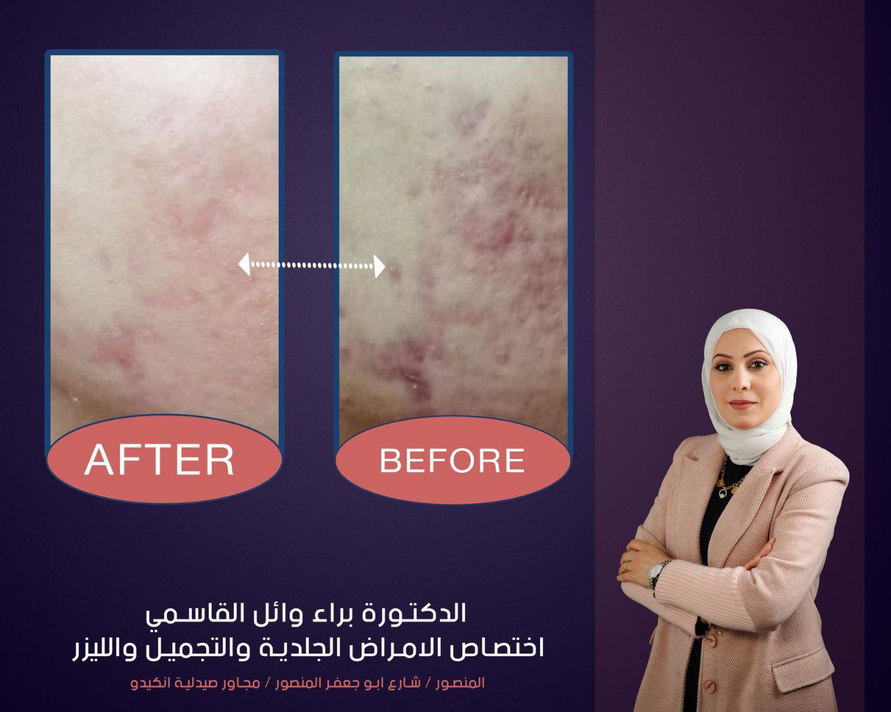 Before and after acne treatment results