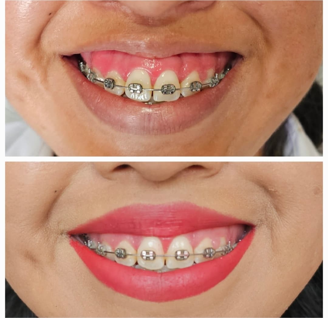 Resultado del tratamiento