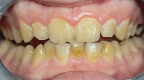 متوفر ازالة تكلسات وتنظيف للاسنان للحالات الي بالصورة
علماً ان العلاج مجاني بالكامل
 للاستفسار والتواصل :
***********
