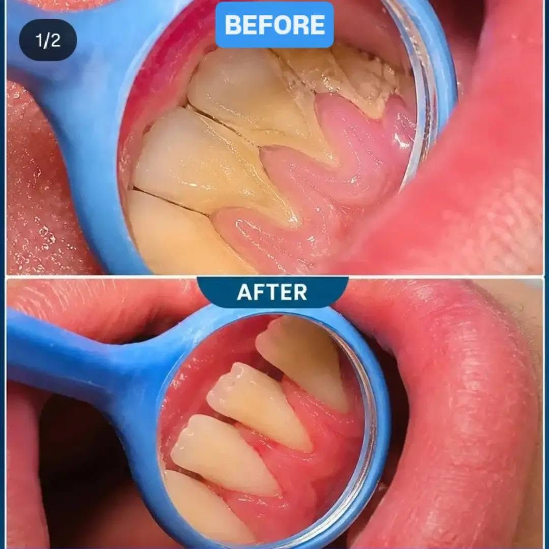 السلام عليكم
مسوين عرض مجاني على تنظيف الاسنان باستخدام جهاز ال ultrasonic scaler ينفتح الحجز من الآن إلى نهاية الزيارة الأربعينية 

باجر اكو مقعد واحد فقط 
والبقية ورا الزيارة 

سارعوا في الحجز 
للحجز والاستفسار: *********** واتساب 
الدكتور : ابراهيم حسن عبد 
العنوان : كربلاء - الحر - جامعة أهل البيت

وهاي عينة من شغلي بنهاية المنشور 
وبالنسبة الي يحب يطلع على بقية اقسام العمل 
يكدر يدخل على الصفحة ويشوف الشغل 

صحة وسلامة إن شاء الله 🌹♥️
