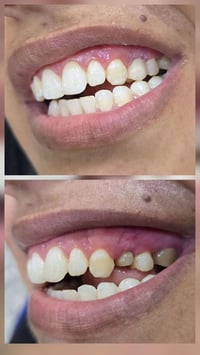 عروض • ابتسامة هوليوود • ضمان مدى الحياة