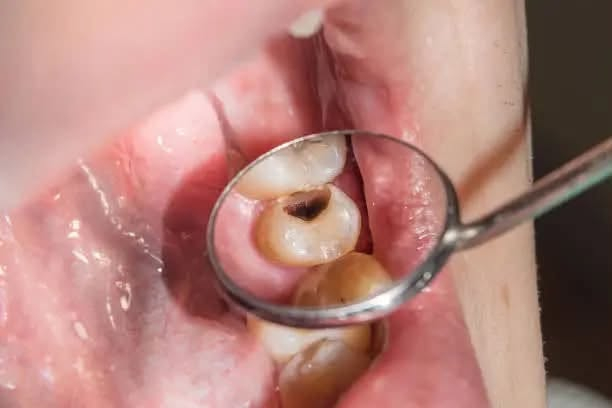 🦷 علاج أسنان مجاناً! 🤍

عندك سن يحتاج قلع؟ حشوة ضوئية؟ تنظيف تكلسات؟
أو عندك أسنان مفقودة وتحتاج طقم جزئي؟ 🦷✨

📍 العلاج في جامعة الفراهيدي – القادسية
👩🏻‍⚕️ تحت إشراف دكاترة وبشكل آمن.

✨ الخدمات:
▫️ قلع
▫️ حشوات ضوئية
▫️ تنظيف تكلسات
▫️ أطقم جزئية للأسنان المفقودة

📩 العدد محدود، واللي مهتم يراسلني خاص حتى نشوف الحالة ونحدد إذا مناسبة للعلاج.
او التواصل على الرقم ***********
🤍 لا تأجل علاج أسنانك… خلي ابتسامتك ترجع مثل قبل!
