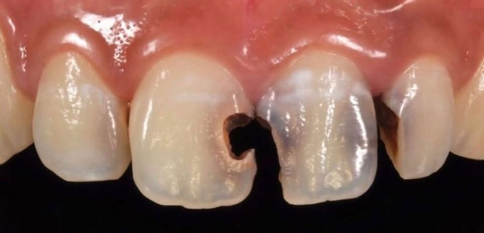 السلام عليكم
🦷🦷متوفر 
⭕️حشوات تجميلية 
 ⭕️تنظيف اسنان 
⭕️قلع الاسنان والجذور المتبقية 
⭕️طقم اسنان جزئي 
❗️العلاج تحت إشراف اطباء اختصاص 
📍العنوان : الدورة / ابو دشير / جامعة كلكامش
 
📞 واتساب :
 ***********

