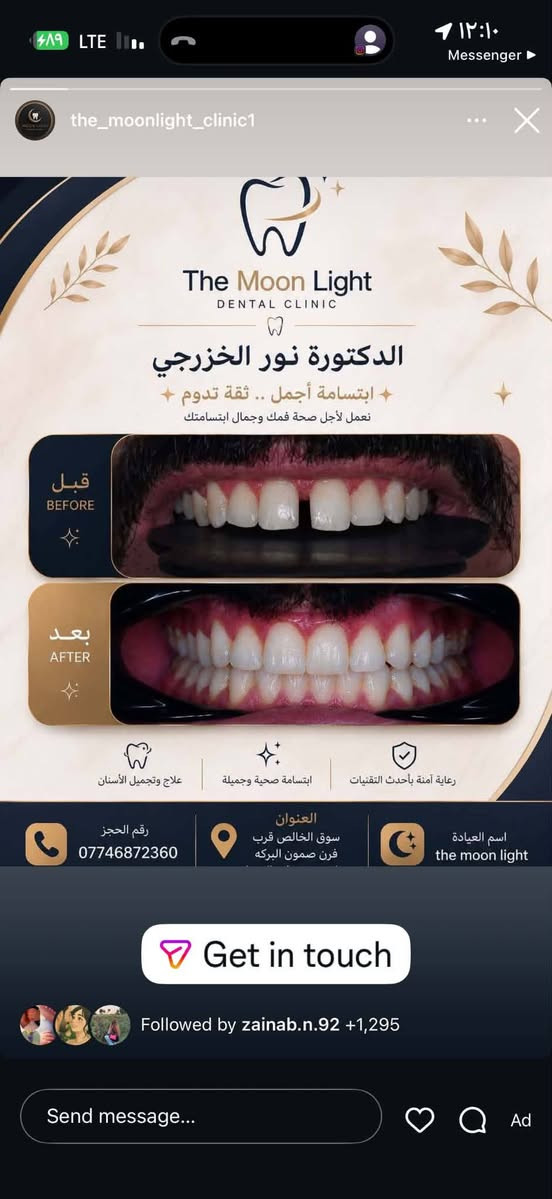 بسم الله وعلى بركة الله ستتواجد الدكتوره نور علي الخزرجي في عيادتها عيادة( the moon light ) لطب وتجميل الفم والاسنان والوجه والفكين
الواقعه في سوق الخالص قرب فرن صمون البركه مجاور مفروشات الزهراء  (وكذلك قسم التجميل الدكتورة ضحى حسين الگمر). يوميا  من الساعه الرابعه عصرا الى الساعه الثامنة مساءا باستثناء يوم الجمعة عطلة العيادة نستقبل حجوزاتكم بكل حب على الرقم *********** وراح تكون اكو هدايا حلوه ومميزه (حقن بلازما وتننظيف اسنان وتبييض اسنان بالليز وكذلك خصم على كافه الحشوات وحشوات الجذور  بنسبة ٢٠٪لمراجعين العياده في الاسبوع الاول من افتتاحنة حبا واحتراما لكم❤️
بسم الله وعلى بركة الله ستتواجد الدكتوره نور علي الخزرجي في عيادتها عيادة( the moon light ) لطب وتجميل الفم والاسنان والوجه والفكين
