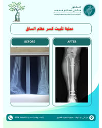 جراحة العظام • تثبيت كسور • جلولاء ديالى