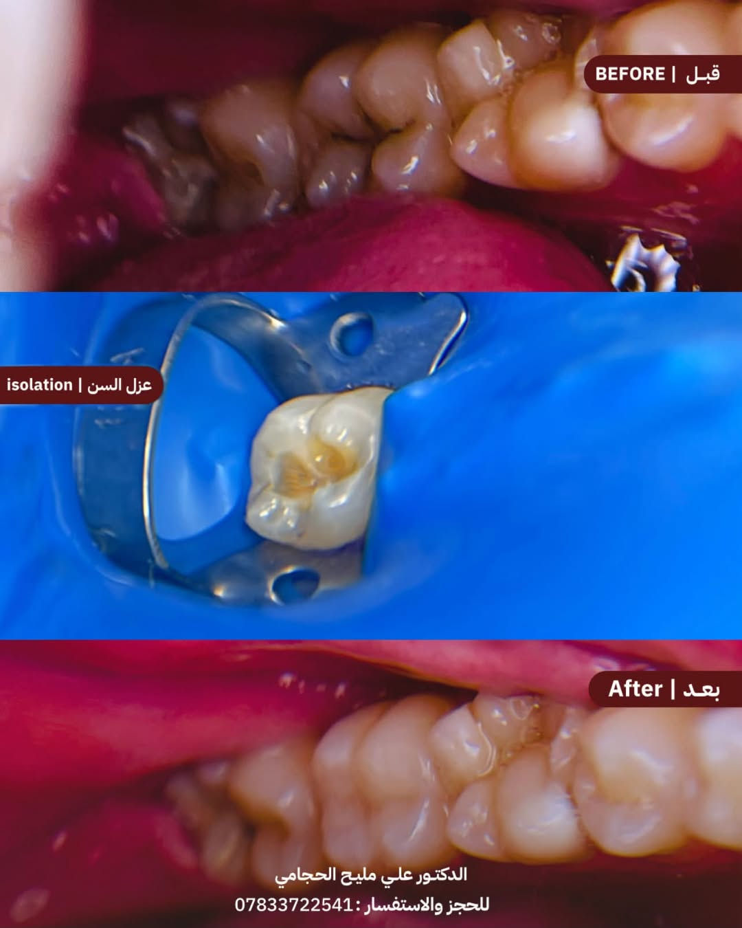 علاج مجاني • تسوس أسنان • عيادات جامعة المشرق