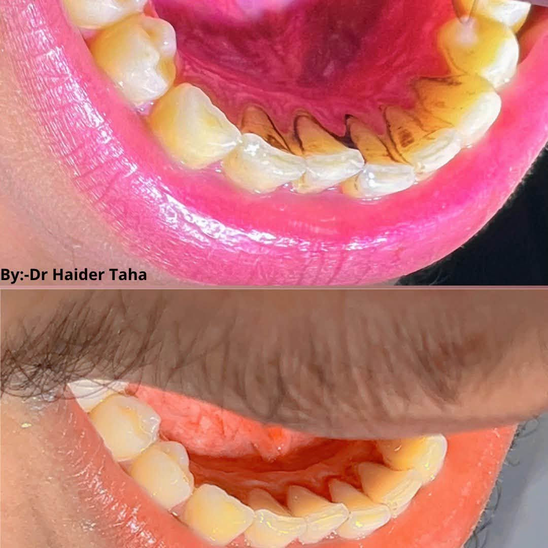 Scaling and polishing 
تنظيف التصبغات وازاله التكلسات 🎖️

نص مكتوب في الصور:
- before after *********** جامعه البيان/بغداد / شارع المطار
- By:-Dr Haider Taha