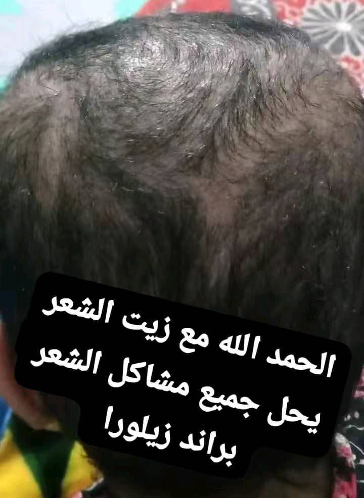 زيت شعر  مناسب لجميع الاعمار ب25,000
توصيل لكل محافظات هذا رقمي ***********