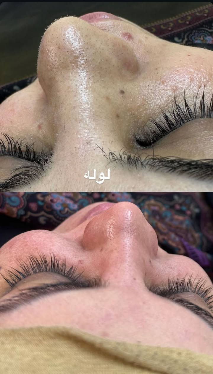 ✨ نضارة بشرتك بتبدأ من التنظيف العميق! ✨
بشرتك بتستحق عناية حقيقية مو بس شكلية. التنظيف العميق مو رفاهية، هو أساس لأي روتين عناية ناجح 
جلسة تنظيف البشره
✔️ تتخلصي من الأوساخ والرواسب
✔️ تحصلي على ترطيب عميق
✔️ تفتحي المسام وتخلي البشرة تتنفس
✔️ تسترجعي إشراقة ونضارة طبيعية

دلّلي نفسج بجلسة تنظيف بشرة مميزة، لأن بشرتك مرآتك.p

نص مكتوب في الصور:
- نظافه البشره يمي غير ✨🔥
- قبل
- بعد الجلسه تنظيف عميق وبشره تلمع بدون رؤس سوداء ✨
- لوله
- بيوتي لوله
- تجديد خلايه بشره نظيفه بدون رؤس وتلمع من النظافه 🔥 ✨