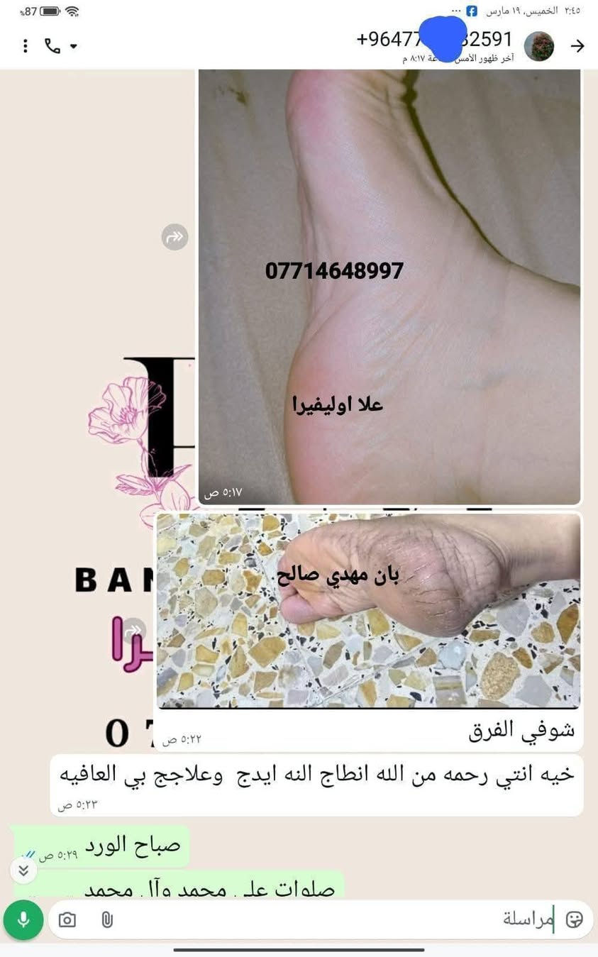 سبب حرارة الصيف واغلبيتنه راح نعاني من تشققات الاقدام وخشونتها بسبب الحراره 😞 ولا يهمكم حبايبي جبتلكم كريم علا اوليفيرا السحري المعجزه بكج كامل 🌟الي راح يخلي اقدامكم نااعمه مثل اقدام الاطفال 💎

نص مكتوب في الصور:
- +964 773 877 *********** شوفى رجلينه كلش جانت يصبن دم والله العضيم ٣ ايام خليته اله العلاج وتعالجن رجليه حتى لايده خليت صارن كلش زينات ***********97
- +964776591
- ***********
- BAN
- علا اوليفيرا!
- بان مهدي صالح
- 077
- مراسلة
- علا اوليفيرا فرع ميسان ***********
- +9647732591 *********** علا اوليفيرا ٠٥:١٧ ص بان مهدي صالح شوفي الفرق ٠٥:٢٢ ص خيه انتي رحمه من الله انطاج النه ايدج وعلاجج بي العافيه ٠٥:٢٣ ص صباح الورد ٠٥:٢٩ ص صلوات عل . محمد هآا . محمد مراسلة
- علا اوليفيرا فرع ميسان *********** هاي قبل العلاج علا اوليفيرا فرع ميسان *********** علا اوليفيرا فرع ميسان *********** هاي بعد االعلاج
- وردة
- نشط الآن
- ٧:٥٩ م
- السلام عليكم
- شخبارج
- حبيت اشوفج الفرق
- ***********
- قبل
- بعد
- علا اوليفيرا فرع ميسان
- ربي يرزقكم ان شاء الله
- ٨:١٩ م
- اللهم صلي على محمد وآل محمد
- لقد قمت بالرد على وردة
- وعليكم السلام ياقلبي
- Aa
- +964 77 2599
- ايي هم نسيت ٠٩:٣٤ م
- ***********
- هاي رجليه اليوم ٠٩:٣٤ م
- بعد استخدام مره وحده ٠٩:٣٥ م
- احسن صار ٠٩:٣٥ م
- صارن ٠٩:٣٥ م
- لصق
- مرحباً! أنا استعمل واتساب. +964 77 علا اوليفيرا فرع ميسان *********** اللهم صلي على محمد وآل محمد اخذت صوره من كلتيلي قبل ماستخدم الخلطه وعلي جان اليل ماينام من الوجع كلساعه يذب عليهن ماي لان يبسن ويشككن بس يدوس بلكاع يطكن دم وعلي نندعيلج وهوه يكول ادعي للمربه لسوتلي رجليه زينات علا اوليفيرا فرع ميسان *********** ياعمري ان شاءالله اكون عند حسن ظنكم يارب ومليون عافيه الكم ياعمري احلى شعور من تراسلوني وانتم فرحانين مراسلة
- علي اولفيرا فرع
- ميسان
- شوفي النتيجه