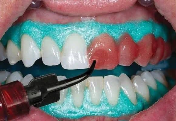 🦷✨ تعلن عيادة الزين لطب الأسنان ✨🦷
🎉 أسبوع تبييض الأسنان المجاني 🎉
لا تفوّتوا الفرصة! 😍
باشروا بالحجز من هسه 📲

📍 العنوان: داخل مجمع بسماية السكني
🏢 بناية دار المعرفة – عمارة مطعم سندريلا

📞 للحجز والاستفسار:
***********

🔥 وعروض جديدة ومميزة بانتظاركم!
⏰ انتظروها اليوم العصر… تنزل قريباً 👀✨

🦷 عيادة الزين لطب الأسنان — ابتسامتك تهمنا 🤍 عياده الزين للاسنان الاسنان
