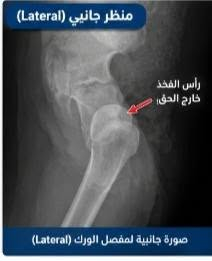خلع الورك الولادي • سونار أطفال • عيادة العامل