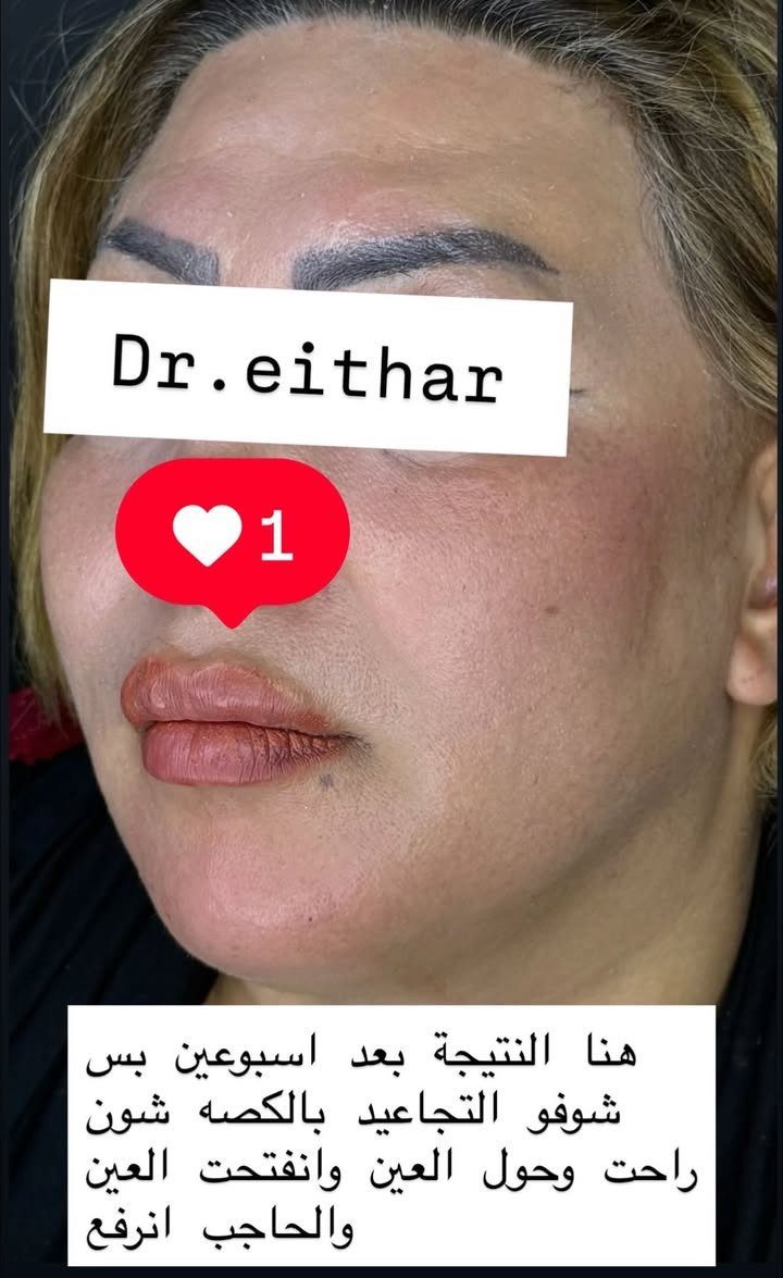شد الوجه بالفلر والمحفزات  (لفتنك وجنات  واصداغ وتدوير الفك والذقن ونظاره وشفة فقط تعديل لان عدهه اختلاف بين الجهتين وبوتوكس  بعد اسبوعين من الحقن ) 🔥🔥🔥

اتمددت عروووض للكادر التدريسي والخريجات والموظفات والعروسات لنهايه الاسبوع ليوم الاربعاء اخر يوم  ثبتتهه الكم بالستوري بالهايلايت وببوست اعلى الصفحة ✨✨

د.ايثار سامي عبد الامير
واسط الكوت الهوره مجمع القبطان طابق اول 

الحجز***********

نص مكتوب في الصور:
- Dr.eithar 1 شد الوجه بالفلر والمحفزات(اصداغ ووجنات وتدوير الفك والذقن) وبوتوكس وشرفة فقط تعديل لان عده جهه بيه تليف نتيجة ضربة قديمه وعاليه
- Dr.eithar
- 1
- هنا النتيجة بعد اسبوعين بس
- شوفو التجاعيد بالكصه شون
- راحت وحول العين وانفتحت العين
- والحاجب انرفع
- Dr.eithar 1 لفتنك اصداغ وجنات وتدوير الفك والذقن بالفلر والمحفزات وبوتوكس وشفة فقط تعديل
- قبل الحقن نزول بالووجنات ومنطقة الفك صغيره وبيهاه نزول وترهل بحيث ماكو فصل بينه وبين اللغلوغ
- قبل الحقن