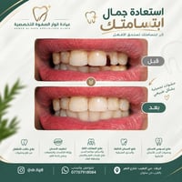 عيادة انوار الصفوة • حشوات تجميلية • علاج لثة
