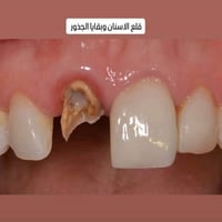 كربلاء حي الموظفين • علاج اسنان مجاني • طقم اسنان