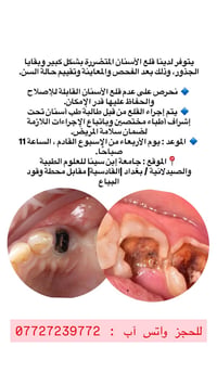 قلع أسنان • جذور باقية • جامعة إبن سينا