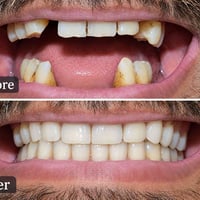 طقم أسنان مجاااني يعوضلك الأسنان المفقودة وترجع ابتسامتك طبيعية .... ا...