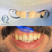 حشوات ضوئية • غلق الفراغات • الشطرة