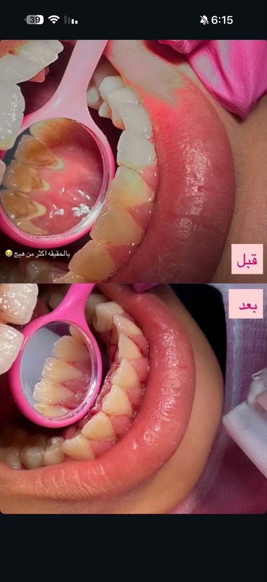 تنظيف اسنان • مجانا • جامعة الزهراوي