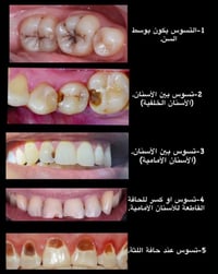 علاج مجاني • جامعة المستقبل • حشوات