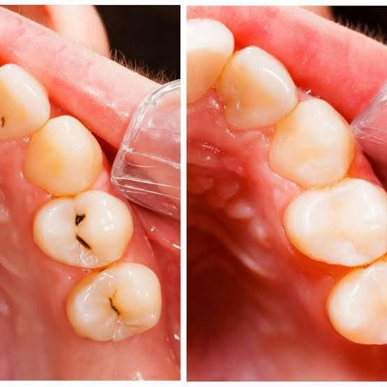 السلام عليكم
احنه طالبات طب اسنان مرحلة رابعة - جامعة السليمانية 
مستعدين لأستقبال حالات قلع، تنظيف، حشوات، بأسعار رمزية او مجاناً (العدد محدود)
(اذا عندك الم غير محتمل بالسن او  جدك او بيبيتك يحتاجون قلع لاسنانهم حتى يسوون تخم ويكدرون ياكلون براحتهم او اذا عندك جذور تريد تقلعهم قبل الزراعة او الجسر، او اذا طفلك اسنانه مسوسة و تريد عيادة مخصصة للاطفال) تعالو تفضلو للعيادة حتى يتم فحص المريض من قبل دكتور الاسنان ويقرر العلاج المناسب

للاستفسار يرجى الرد على البوست او ارسال رسالة على الخاص  او الرقم ***********
او تواصلو مباشرةً على الصفحة
