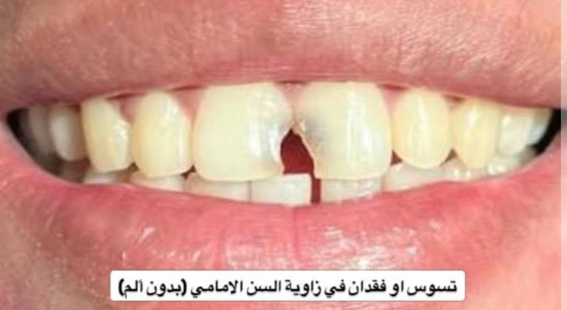 علاج مجاني • تنظيف اسنان • تسوس جانبي