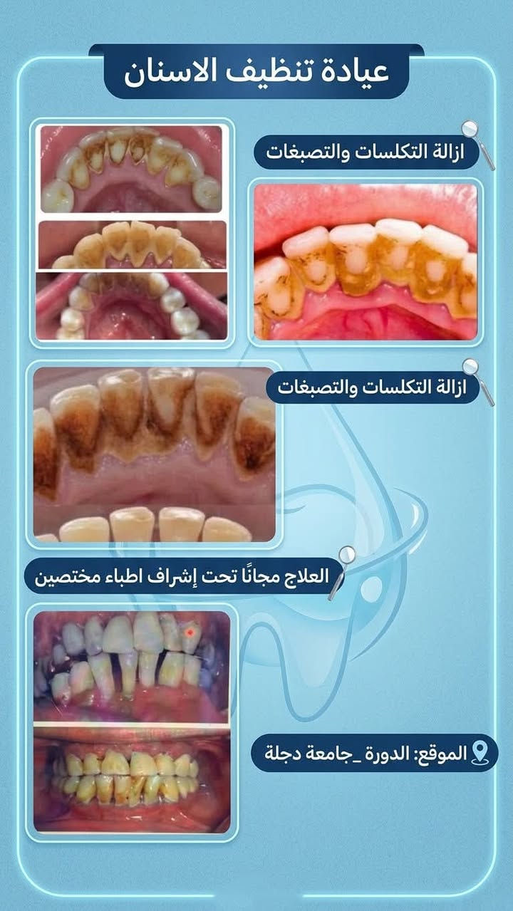 🦷 ابتسامتك وصحة أسنان عائلتك بأيدٍ أمينة… ومجاناً بالكامل ...

تحت إشراف نخبة من الأطباء والأخصائيين، يعلن فريق  طبي متخصص  من الكوادر النسائية في جامعة دجلة عن استقبال الحالات المرضية لتوفير الفحص والعلاج مجاناً بالكامل (100%) دون تحمل أي أجور للكشفية أو المواد أو العمل العلاجي.

✨ علاج مجاني بالكامل | أجهزة حديثة | إشراف طبي متخصص | عناية وتعقيم بأعلى المستويات

ويتم تقديم العلاج تحت إشراف مباشر من طبيبات أخصائيات، حرصاً على الدقة وجودة العمل وسلامة المراجعين.

👧 عيادة الأطفال | من عمر 4 إلى 11 سنة

تشمل الخدمات:
• علاج تسوس الأسنان وحشوات الأسنان اللبنية.
• قلع الأسنان التالفة أو المتحركة بعناية وحرص.
• تنظيف الأسنان.
• سد الفجوات للمساعدة في حماية أسنان الطفل من التسوس.

👩 عيادة النساء | جميع الأعمار

تشمل الخدمات:
• الحشوات التجميلية والحشوات الاعتيادية.
• تنظيف الأسنان وإزالة التكلسات والتصبغات.
• تعويض الأسنان المفقودة من خلال أطقم الأسنان والجسور.

👴 عيادة كبار السن | من عمر 60 سنة فما فوق

• صناعة وتعويض أطقم الأسنان الكاملة والجزئية للفك العلوي والسفلي.
• المساعدة على استعادة القدرة على المضغ وتحسين وظيفة وشكل الأسنان.

📍 الموقع:
بغداد – الدورة – شارع المصافي – جامعة دجلة الأهلية

💰 التكلفة:
مجــانــاً 100%
دون أي رسوم للكشفية أو المواد أو العمل العلاجي.

🩺 خصوصيتك وسلامتك أولويتنا
كادر طبي نسائي، مع الالتزام بأعلى معايير التعقيم والعناية أثناء تقديم الخدمات العلاجية.

📩 للحجز والاستفسار:
يرجى إرسال رسالة خاصة لغرض الفرز وتحديد الأولوية، أو التواصل عبر الواتساب:
📞  ***********

✨ لا تؤجل علاج أسنانك… ولا تحرم طفلك من ابتسامة صحية.
احجز الآن واستفد من العلاج المجاني بالكامل في العيادات التعليمية بجامعة دجلة الأهلية.

نص مكتوب في الصور:
- عناية بابتسامات أطفالنا
- صحة أسنان طفلك، أمان وثقة.
- وكل مشاكل اسنان الاطفال 💙
- بغداد/الدورة/ شارع المصافي/جامعه دجلة 📍
- للحجز والاستفسار: 📷 📞 ***********
- جامعة دجلة Digla University Dental Clinic مركز طب الأسنان التابع لجامعة دجلة - خدمات علاجية شاملة تسوس الأضراس الخلفية كسر في الأسنان الأمامية تراجع اللثة وتآكل الأسنان كسر في السن السفلي • العلاج المجاني تحت إشراف أخصائيين برعاية كلية طب الأسنان - جامعة دجلة • الموقع حي الدورة, بغداد, العراق - مبنى جامعة دجلة www.diglauniversity info@digladeals.com 024-973727
- عيادة تنظيف الاسنان
- ازالة التكلسات والتصبغات
- العلاج مجانًا تحت إشراف اطباء مختصين
- الموقع: الدورة _جامعة دجلة
- طقم الأسنان المتحرك
- حل احترافي لتعويض الأسنان
- تعويض الأسنان المفقودة من خلال طقم الأسنان المتحرك
- حلول عملية ومريحة لاستعادة ابتسامتك
- العنوان: بغداد - الدورة - شارع المصافي
- عيادة جامعة دجلة
- للحجز: + ***********
- الخطة العلاجية المقترحة العلاج مجاناً تحت اشراف اطباء مختصين قلع الاسنان التالفة وبقايا جذور الدورة_جامعة دجلة للتواصل والحجز: *********** @generic جامعة دجلة Al-Dajla University
