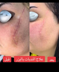 ✨ ودّعي آثار الجروح والعمليات القديمة ✨  ندب الجروح والعمليات ممكن تبق...