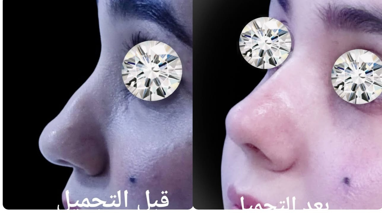 تجميل الانف الغضروفي المنتفخ.. Bulbous Rhinoplasty
***********

نص مكتوب في الصور:
- بعد التجميل قبل التجميل
- قبل التجميل
- بعد التجميل
- قبل التحميل بعد التحميل