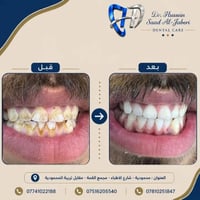 🦷✨ قبل وبعد تنظيف وتبييض الأسنان إزالة التصبغات واستعادة إشراقة الأسنا...