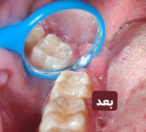 حشوة ضوئية دائمة • مجانا • الحله شارع 40