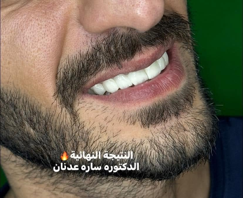 ابتسامة هوليود • زاركون ايماكس • ضمان مدى الحياة