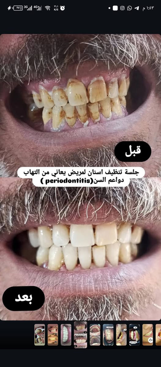 تنظيف اسنان • طقم متحرك • قلع جذور