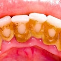تنظيف الاسنان • تكلسات • علاج سهل